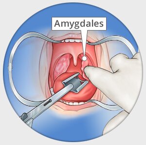 Chirurgie ablation des amygdales, amygdalectomie enfant Paris