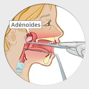 Chirurgie ablation de vegetations adenoides enfant Paris